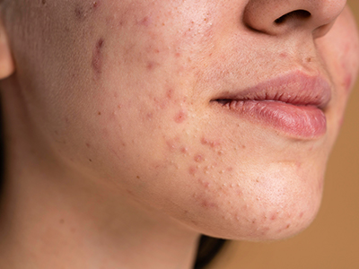 Why Women Hair Transplant